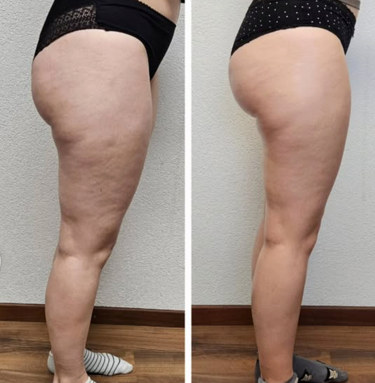 Bye Bye Cellulite - EMS Beauty Gerät mit Wärme