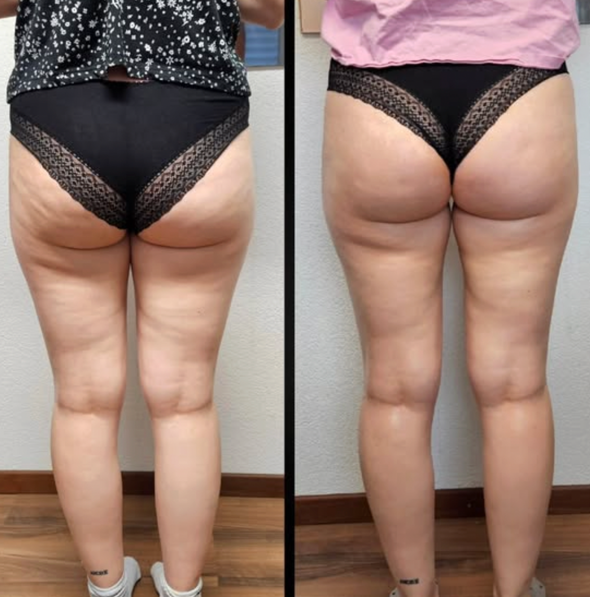 Bye Bye Cellulite - EMS Beauty Gerät mit Wärme