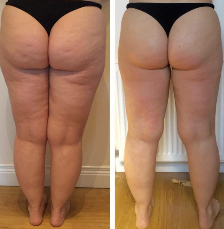 Bye Bye Cellulite - EMS Beauty Gerät mit Wärme