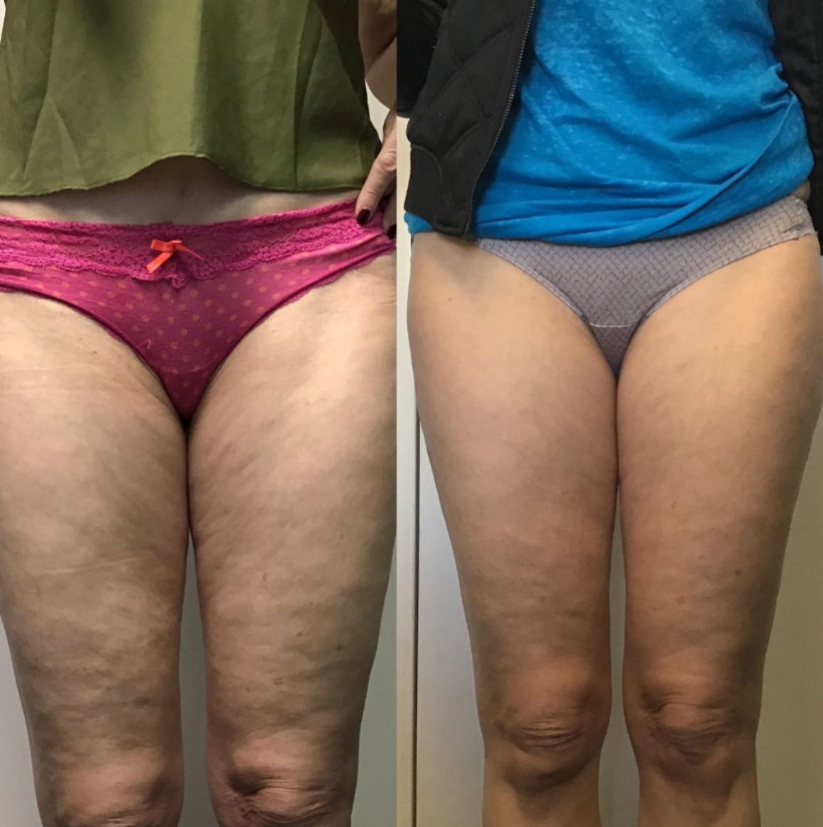 Bye Bye Cellulite - EMS Beauty Gerät mit Wärme
