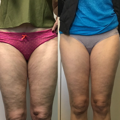 Bye Bye Cellulite - EMS Beauty Gerät mit Wärme